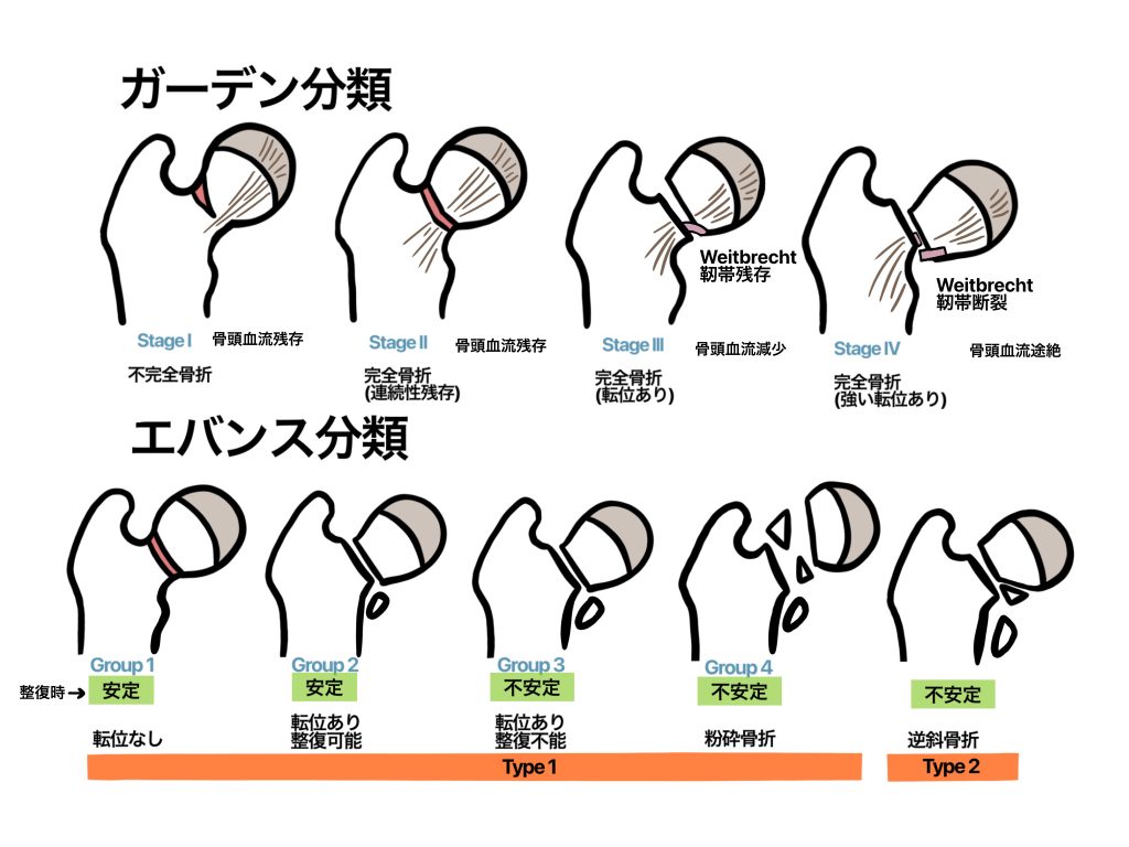 骨折の分類