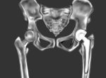 【人工骨頭置換術後のリハビリ】大腿骨頸部骨折