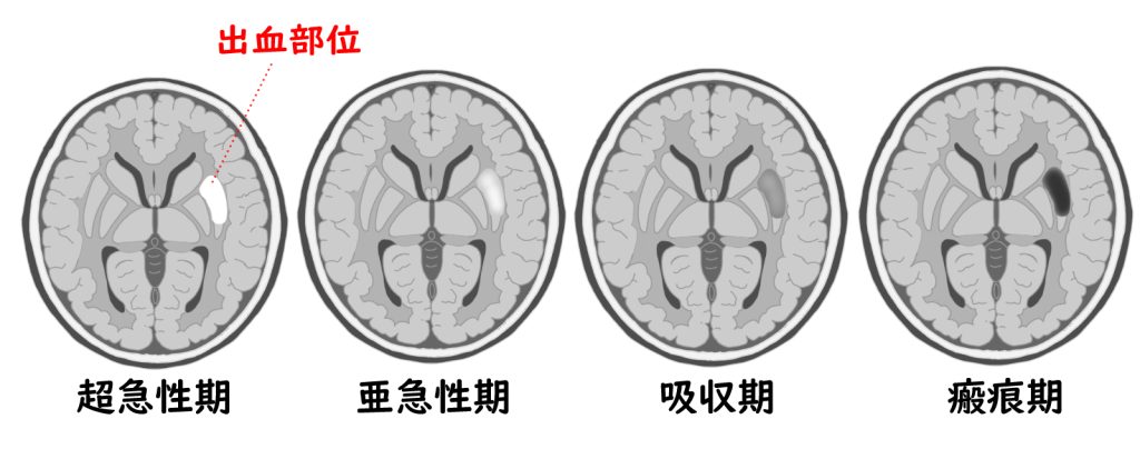 被殻出血　脳画像
